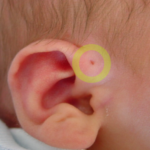 Các dị tật tai ở trẻ sơ sinh