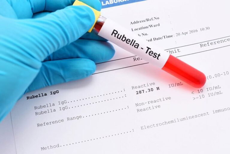 Khi nào cần xét nghiệm Rubella? Ý nghĩa kết quả xét nghiệm?