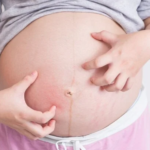 Ứ mật thai kỳ gây ngứa?