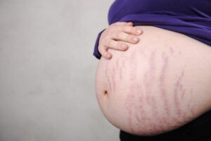 Điều gì khiến bạn dễ bị rạn da khi mang thai?