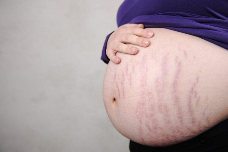 Điều gì khiến bạn dễ bị rạn da khi mang thai?
