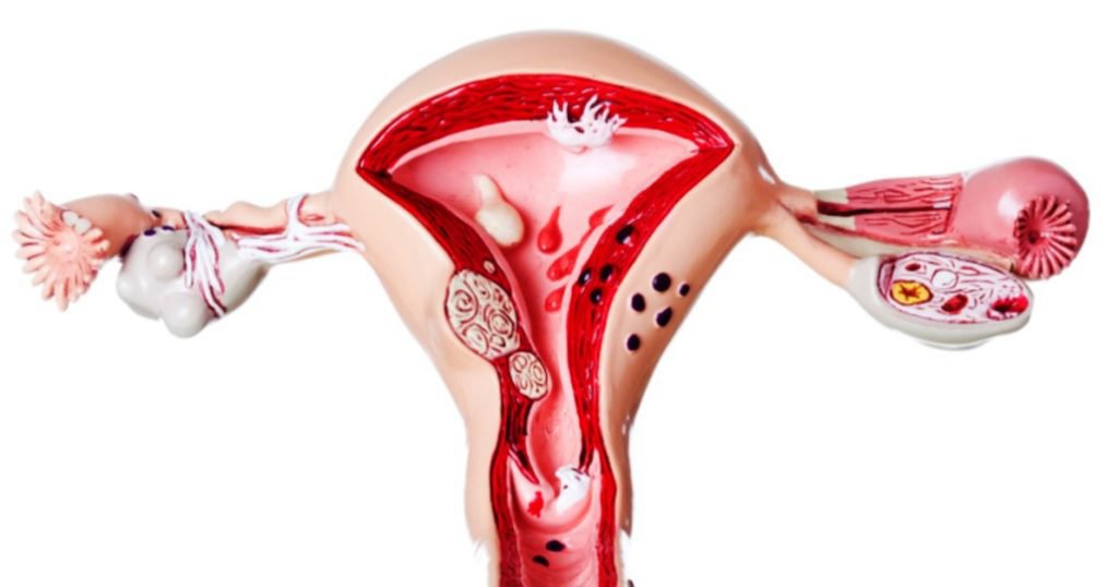 Lạc nội mạc tử cung và ảnh hưởng của nó tới khả năng mang thai