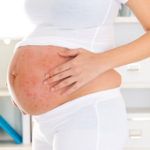 Bị thủy đậu khi mang thai: Điều trị thế nào?