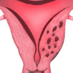Lạc nội mạc tử cung và nguy cơ sảy thai