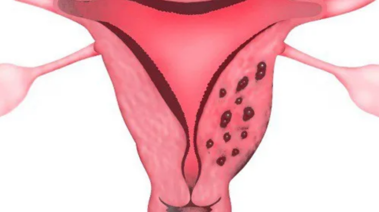 Lạc nội mạc tử cung và nguy cơ sảy thai
