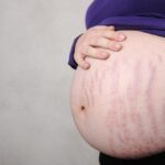 Rạn da khi mang thai: Tại sao người bị, người không?
