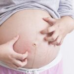 Cách hạn chế ngứa bụng trong thai kỳ