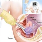 Vai trò của siêu âm qua đường âm đạo trong thai kỳ