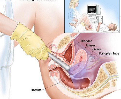 Vai trò của siêu âm qua đường âm đạo trong thai kỳ