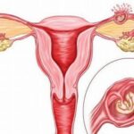 Các biến chứng có thể gặp sau mổ thai ngoài tử cung