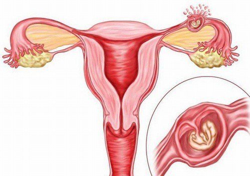 Các biến chứng có thể gặp sau mổ thai ngoài tử cung