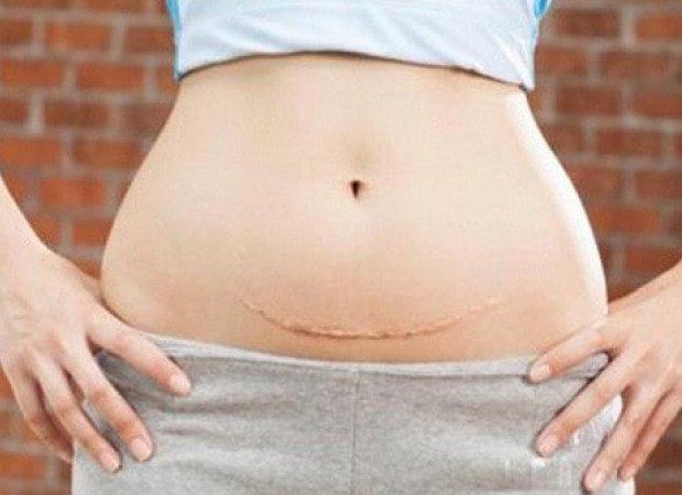 Có thể mang thai tự nhiên sau mổ thai ngoài tử cung 2 lần không?