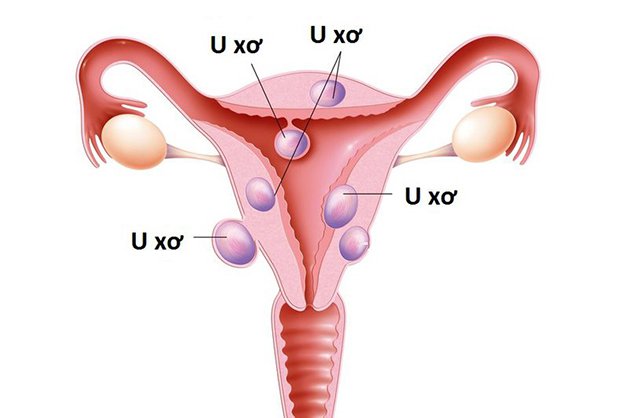 U xơ tử cung kích thước 5cm khi mang thai 10 tuần có sao không?