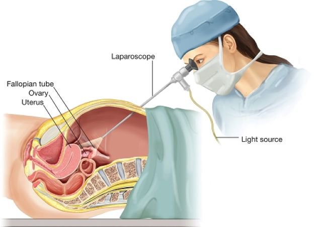 Phẫu thuật thai ngoài tử cung có cắt ống dẫn trứng không?