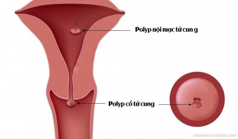 Đã xoắn polyp tử cung có thể mang thai không?