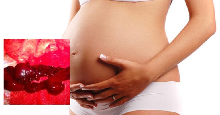 Mang thai 5 tháng bị đau bụng dưới, ra máu tươi đỏ thẫm có sao không?
