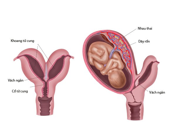 Thai 4,5 tuần tử cung 2 sừng có phôi thai hình bầu dục thì có sao không?