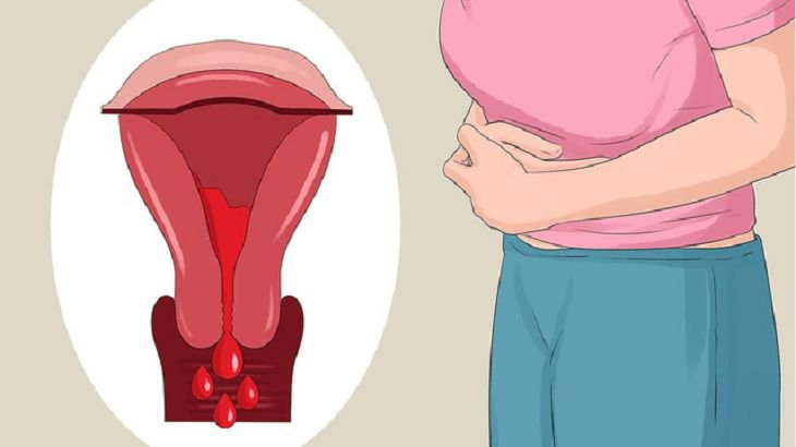 Ra máu âm đạo màu nâu kèm đau bụng là dấu hiệu của bệnh gì?