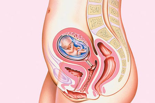 Phương pháp điều trị thai ở cửa tử cung?