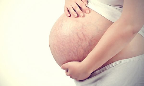 Suy giãn tĩnh mạch chân phải khi mang thai 7 tháng điều trị thế nào?