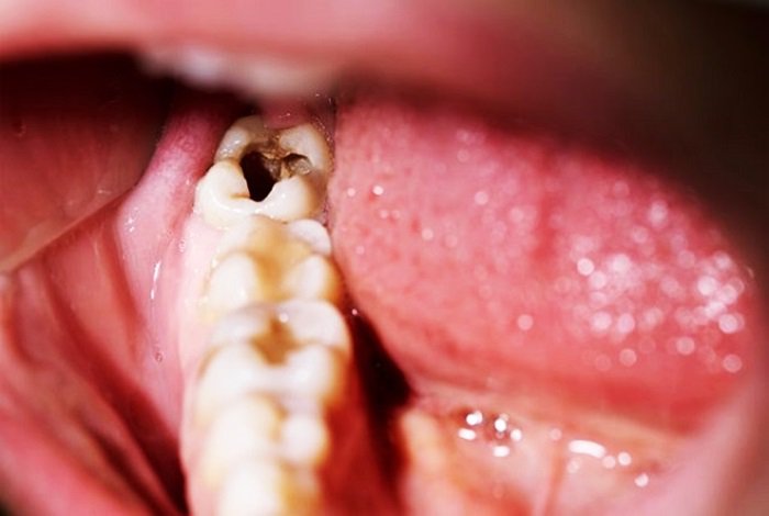 Mang thai 2 tháng có thể điều trị sâu răng hàm được không?